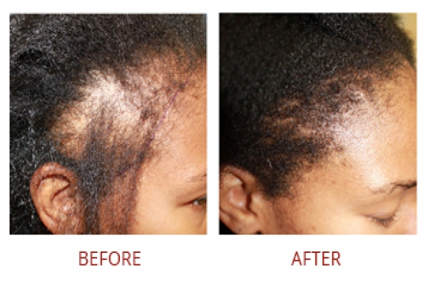 smp before after right