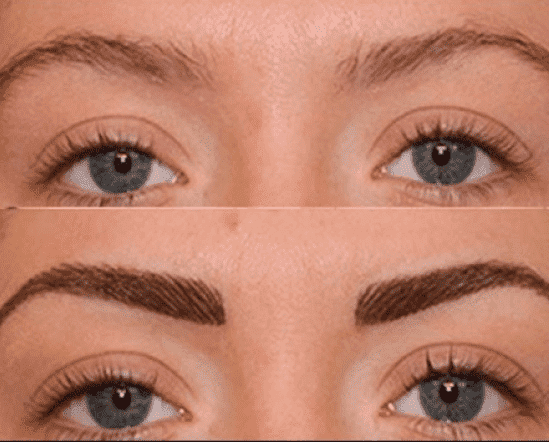 Eyebrow Restoration