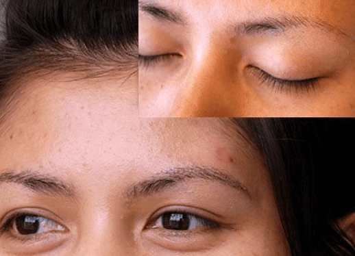 Textured Hair Restoration Surgeries Work