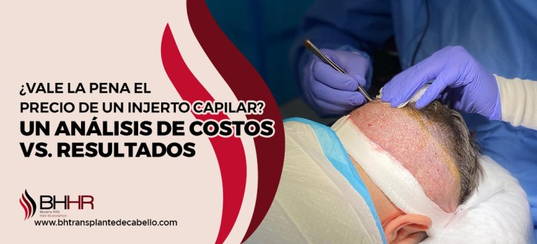 injerto capilar precio