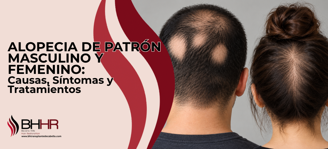 Alopecia de patrón masculino y femenino