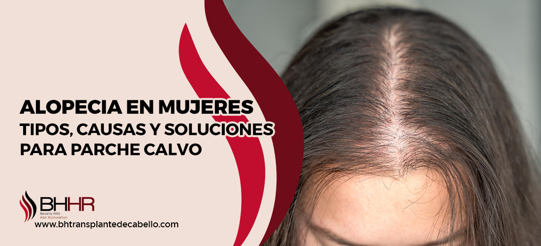 tipos de alopecia en mujeres