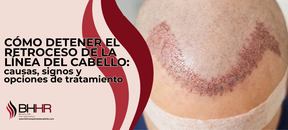 Como detener el retroceso de la linea capilar