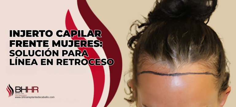 Injerto Capilar Frente Mujeres