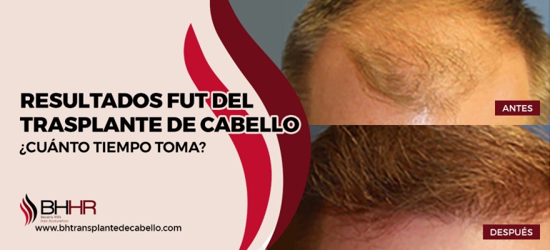 resultados fut del trasplante de cabello