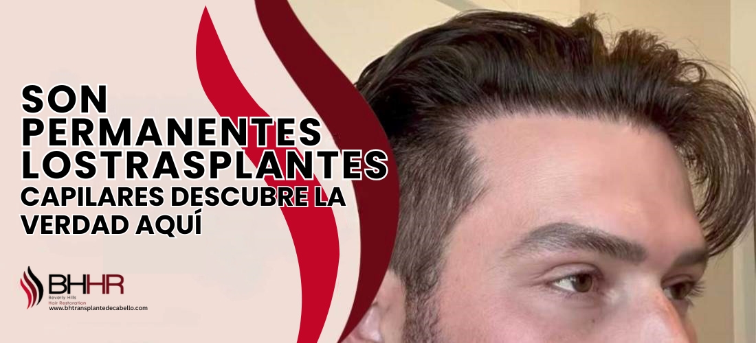 ¿Son permanentes los trasplantes capilares