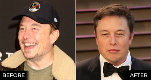 ELON MUSK'S HAIR TRANSPLANT