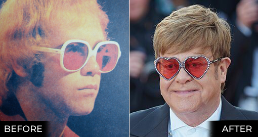 ELTON JOHN'S HAIR TRANSPLANT