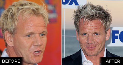 GORDON RAMSAY'S HAIR TRANSPLANT