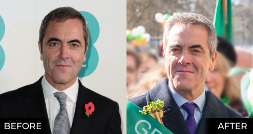 JAMES NESBITT'S HAIR TRANSPLANT