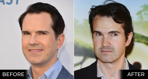 JIMMY CARR'S HAIR TRANSPLANT
