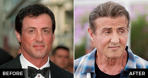 SYLVESTER STALLONE HAIR TRANSPLANT