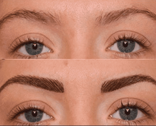 ¿QUÉ ES EL TRASPLANTE DE CEJAS?