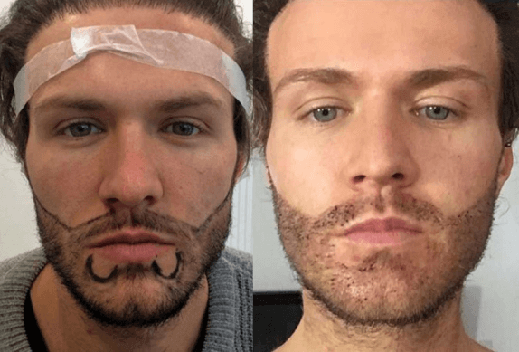 ¿QUÉ ES EL TRASPLANTE DE BARBA?