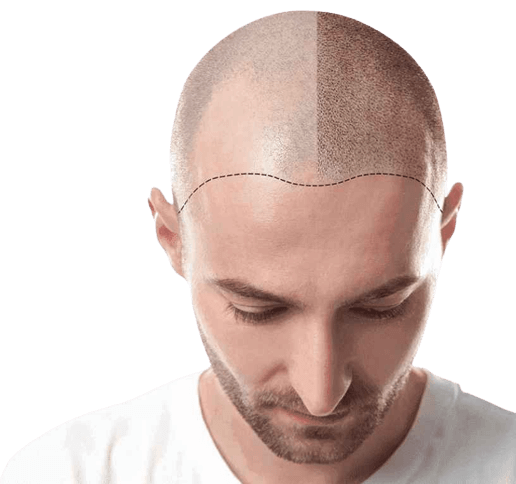 ¿QUÉ ES LA MICROPIGMENTACIÓN CAPILAR?