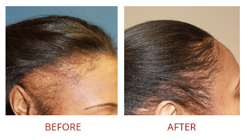 hair-transplant-strip-fut