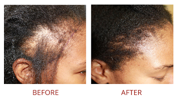 hair-transplant-strip-fut